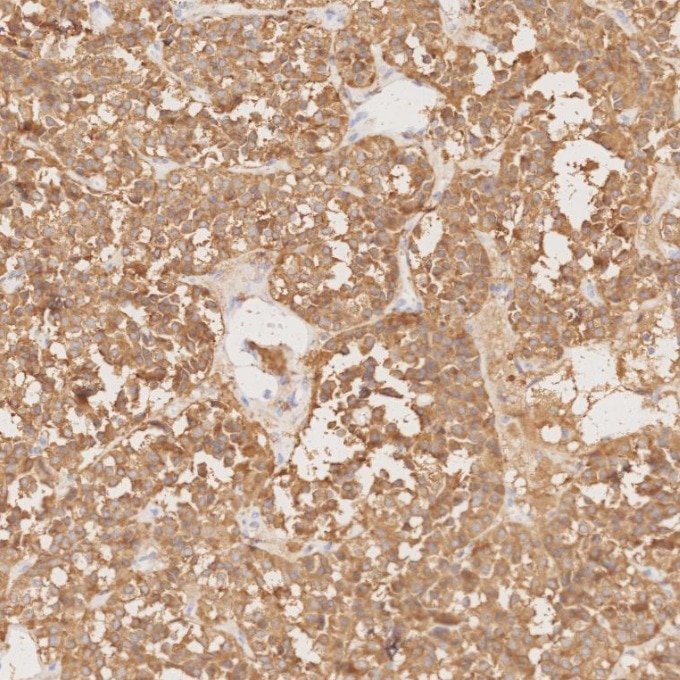 IHC staining of human pituitary adenoma using 67864-1-Ig Immunohistochemistry (IHC) staining of human pituitary adenoma tissue using Synaptophysin Monoclonal antibody (67864-1-Ig)