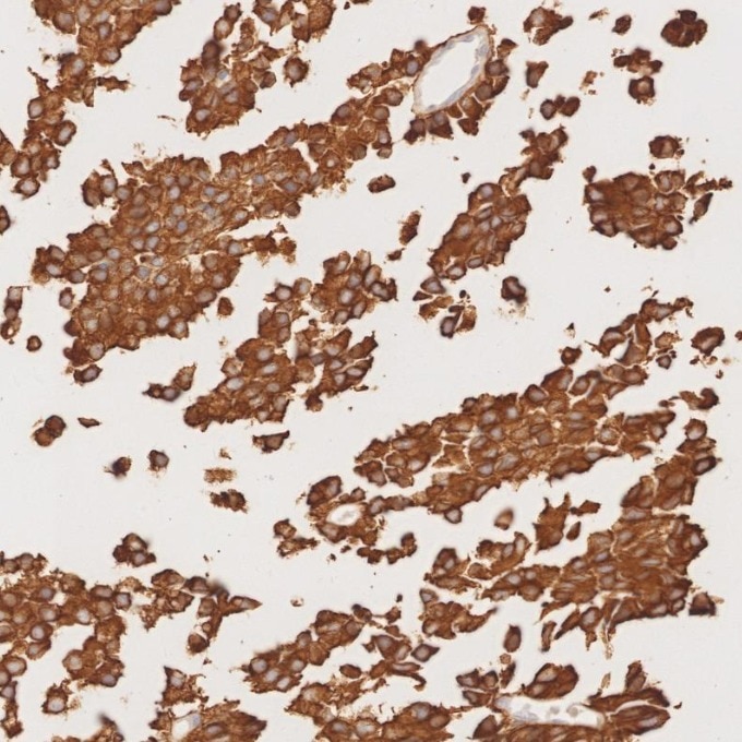 IHC staining of human pituitary adenoma using 67864-1-Ig Immunohistochemistry (IHC) staining of human pituitary adenoma tissue using Synaptophysin Monoclonal antibody (67864-1-Ig)