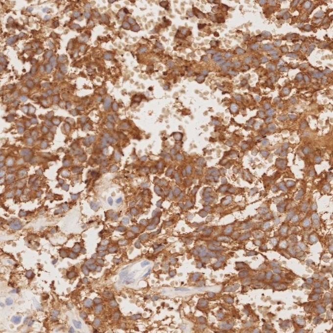IHC staining of human pituitary adenoma using 67864-1-Ig Immunohistochemistry (IHC) staining of human pituitary adenoma tissue using Synaptophysin Monoclonal antibody (67864-1-Ig)