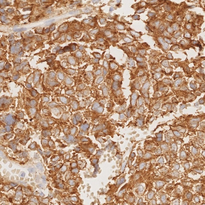 IHC staining of human pituitary adenoma using 67864-1-Ig Immunohistochemistry (IHC) staining of human pituitary adenoma tissue using Synaptophysin Monoclonal antibody (67864-1-Ig)