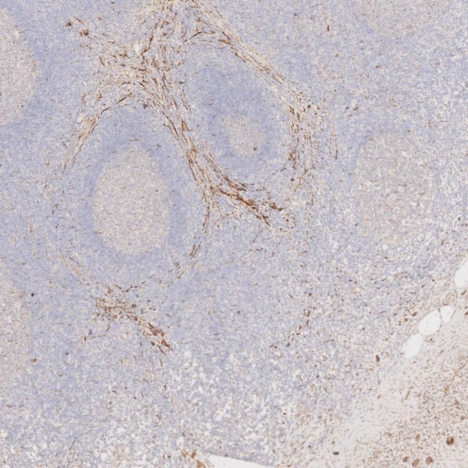 IHC staining of human appendicitis using 67864-1-Ig Immunohistochemistry (IHC) staining of human appendicitis tissue using Synaptophysin Monoclonal antibody (67864-1-Ig)