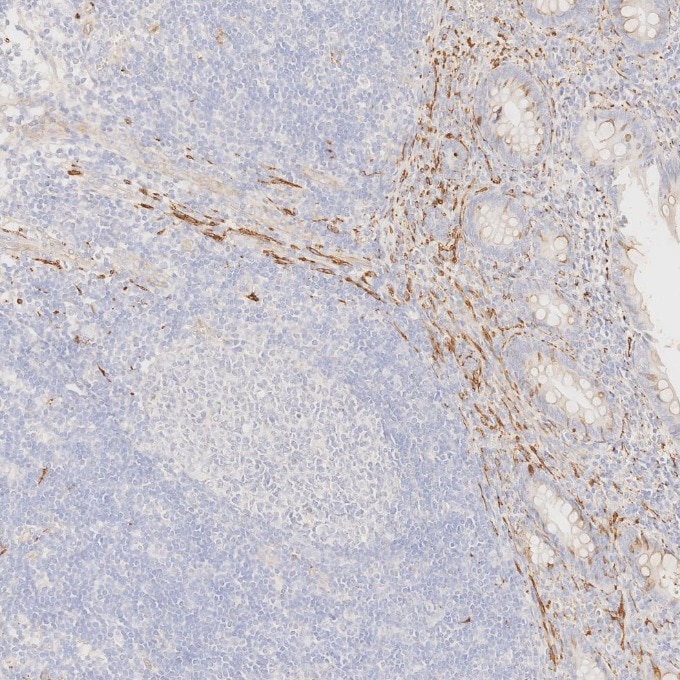 IHC staining of human appendicitis using 67864-1-Ig Immunohistochemistry (IHC) staining of human appendicitis tissue using Synaptophysin Monoclonal antibody (67864-1-Ig)