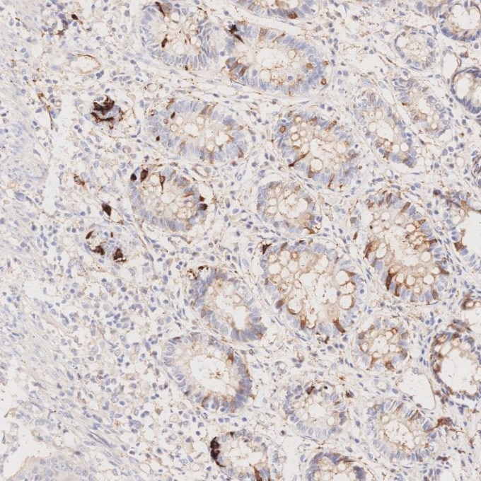 IHC staining of human colorectal cancer using 67864-1-Ig Immunohistochemistry (IHC) staining of human colorectal cancer tissue using Synaptophysin Monoclonal antibody (67864-1-Ig)