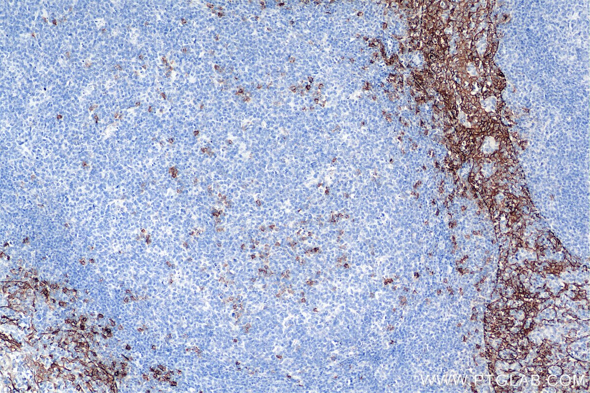 Immunohistochemistry (IHC) staining of human tonsillitis tissue using Syndecan-1/CD138 Recombinant antibody (84069-8-RR)