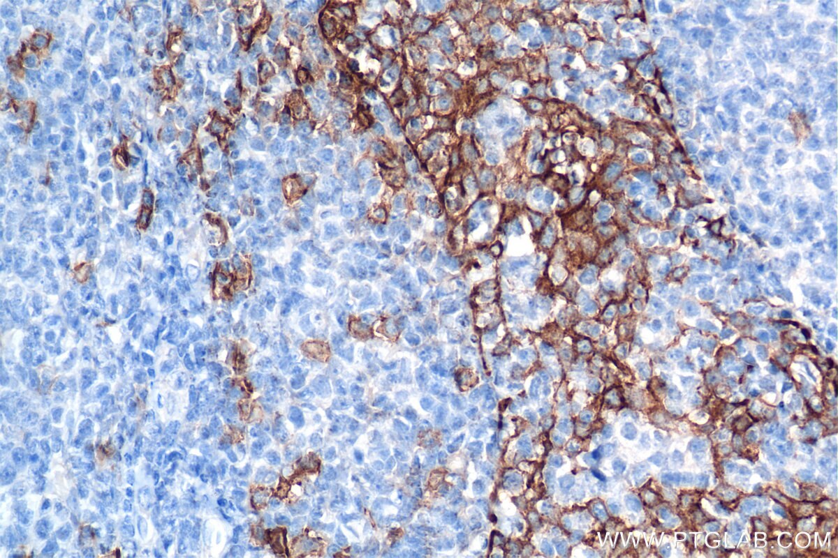 Immunohistochemistry (IHC) staining of human tonsillitis tissue using Syndecan-1/CD138 Recombinant antibody (84069-8-RR)