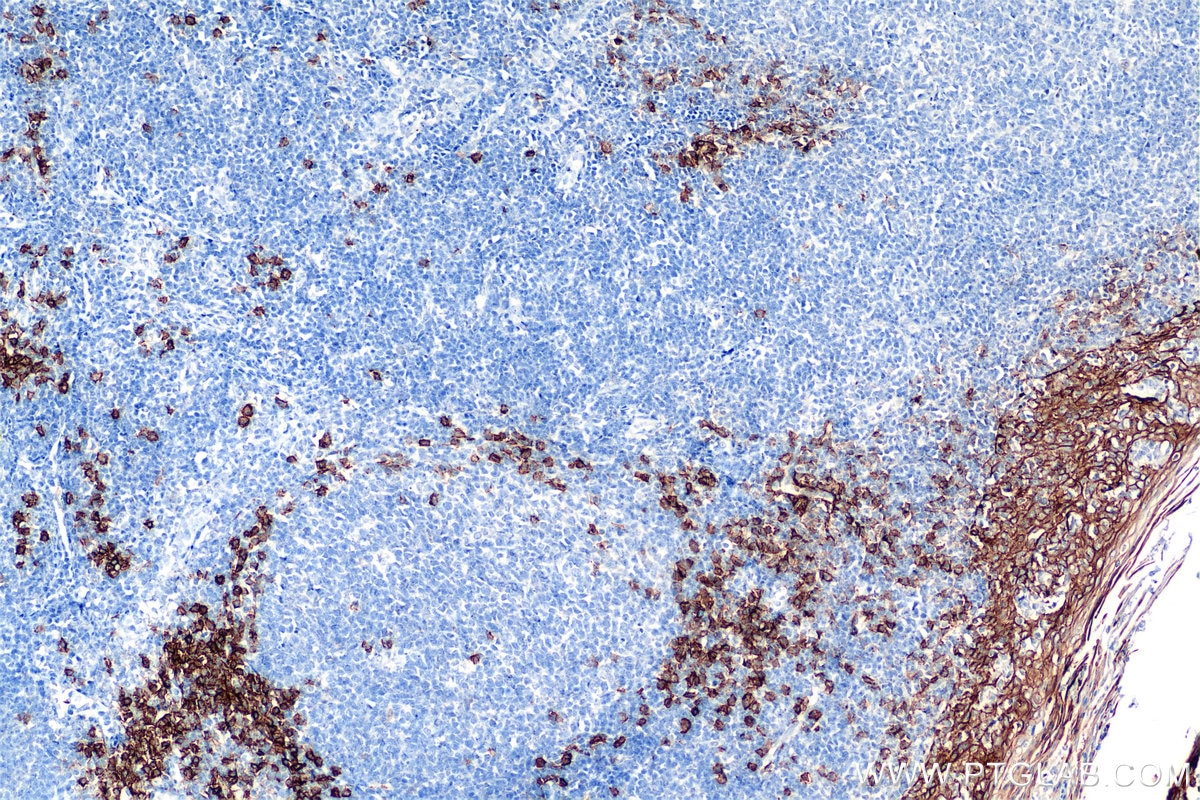 Immunohistochemistry (IHC) staining of human tonsillitis tissue using Syndecan-1/CD138 Recombinant antibody (84069-8-RR)
