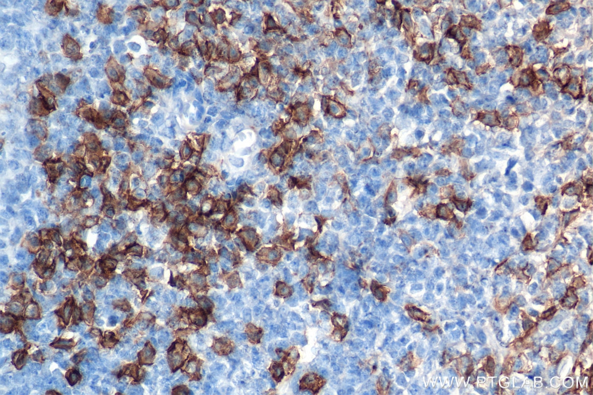 Immunohistochemistry (IHC) staining of human tonsillitis tissue using Syndecan-1/CD138 Recombinant antibody (84069-8-RR)