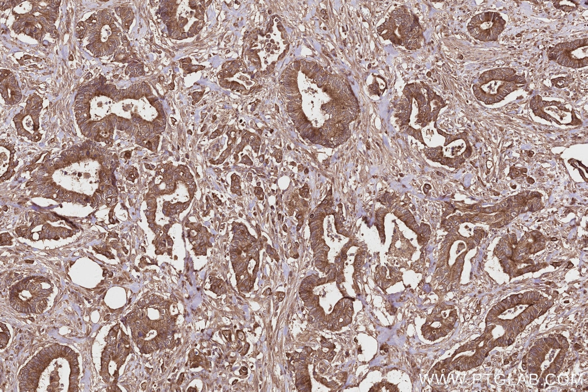 IHC staining of human rectal cancer using 27749-1-AP Immunohistochemistry (IHC) staining of human rectal cancer tissue using Syndetin/CCDC132 Polyclonal antibody (27749-1-AP)