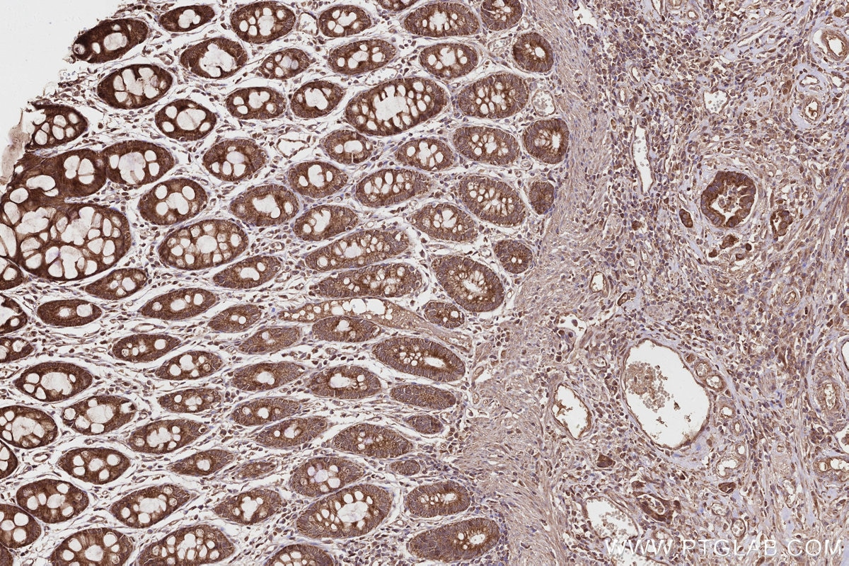 IHC staining of human rectal cancer using 27749-1-AP Immunohistochemistry (IHC) staining of human rectal cancer tissue using Syndetin/CCDC132 Polyclonal antibody (27749-1-AP)