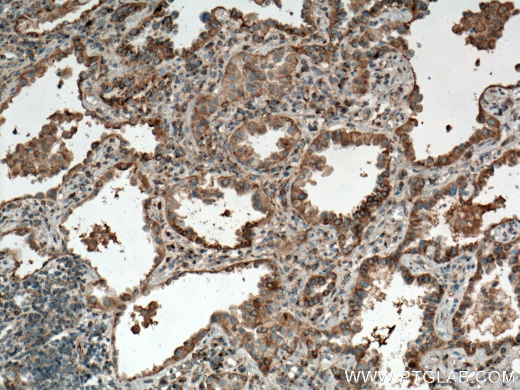 Immunohistochemistry (IHC) staining of human lung cancer tissue using Syntaxin 16 Monoclonal antibody (66775-1-Ig)