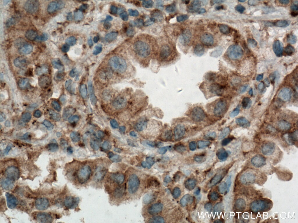 Immunohistochemistry (IHC) staining of human lung cancer tissue using Syntaxin 16 Monoclonal antibody (66775-1-Ig)