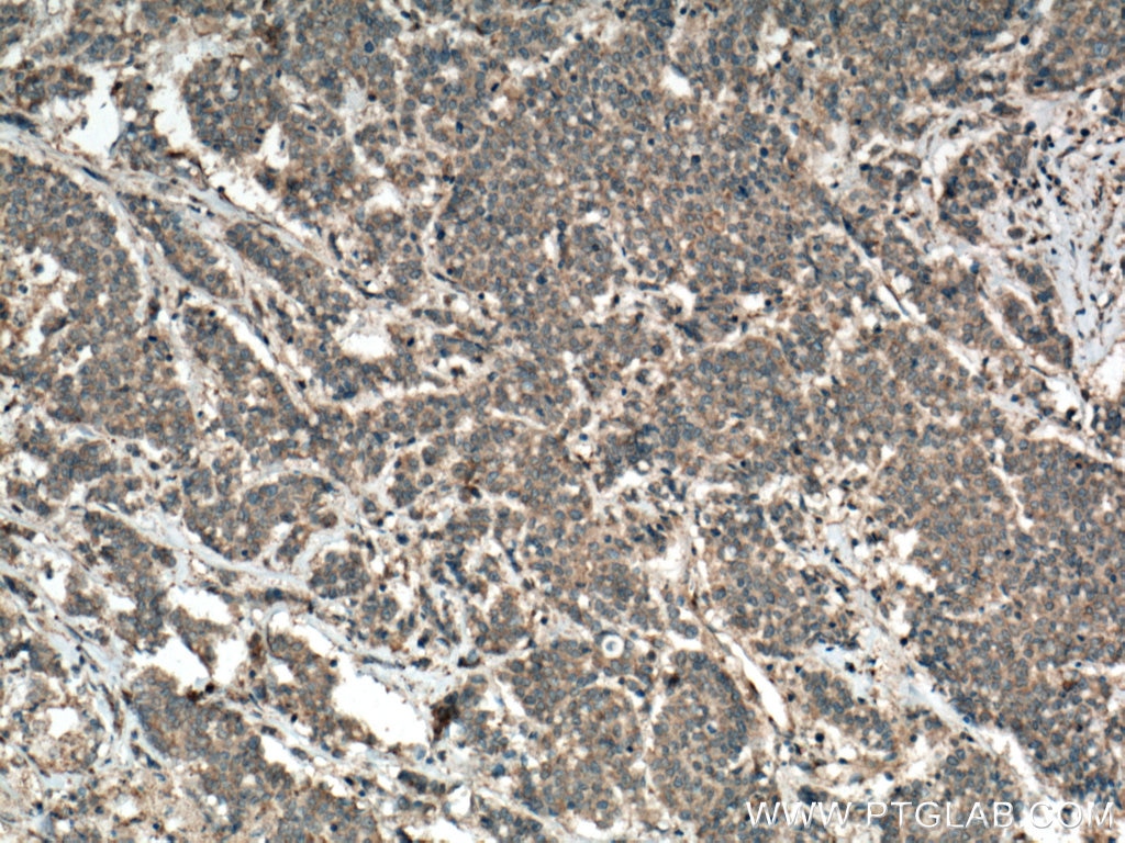 Immunohistochemistry (IHC) staining of human colon cancer tissue using Syntaxin 16 Monoclonal antibody (66775-1-Ig)
