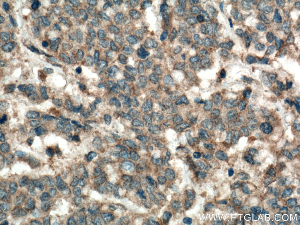 Immunohistochemistry (IHC) staining of human colon cancer tissue using Syntaxin 16 Monoclonal antibody (66775-1-Ig)