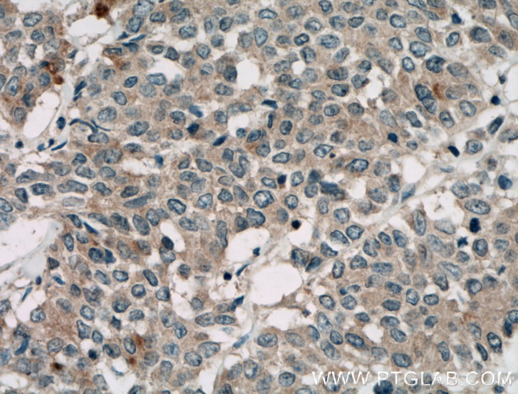 Immunohistochemistry (IHC) staining of human colon cancer tissue using TAB1 Polyclonal antibody (27566-1-AP)