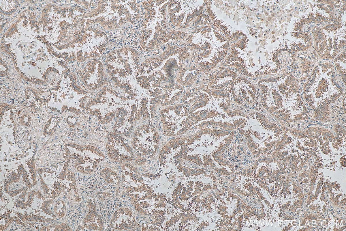 Immunohistochemistry (IHC) staining of human lung cancer tissue using TAB1 Monoclonal antibody (67020-1-Ig)