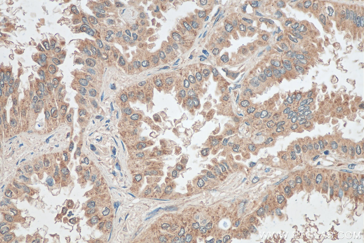 Immunohistochemistry (IHC) staining of human lung cancer tissue using TAB1 Monoclonal antibody (67020-1-Ig)