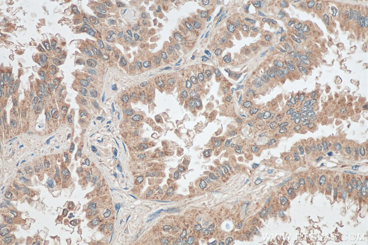 IHC staining of human lung cancer using 67020-1-Ig