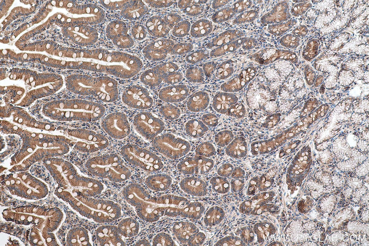 Immunohistochemistry (IHC) staining of human stomach cancer tissue using TACC1 Polyclonal antibody (13862-1-AP)