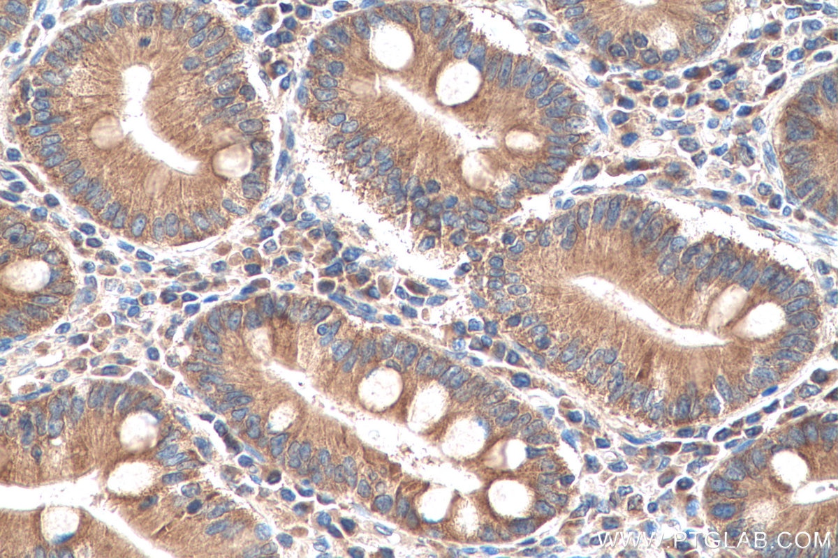 Immunohistochemistry (IHC) staining of human stomach cancer tissue using TACC1 Polyclonal antibody (13862-1-AP)