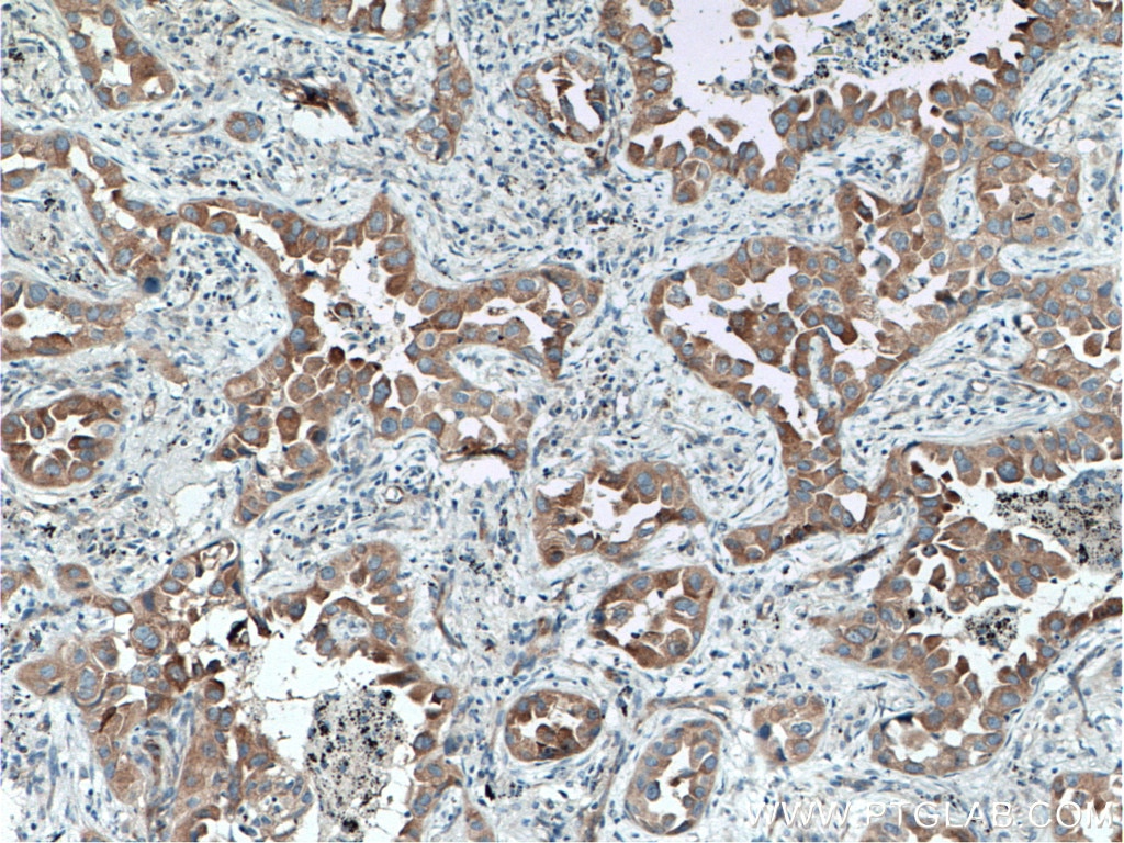 Immunohistochemistry (IHC) staining of human lung cancer tissue using TACC2 Polyclonal antibody (11407-1-AP)