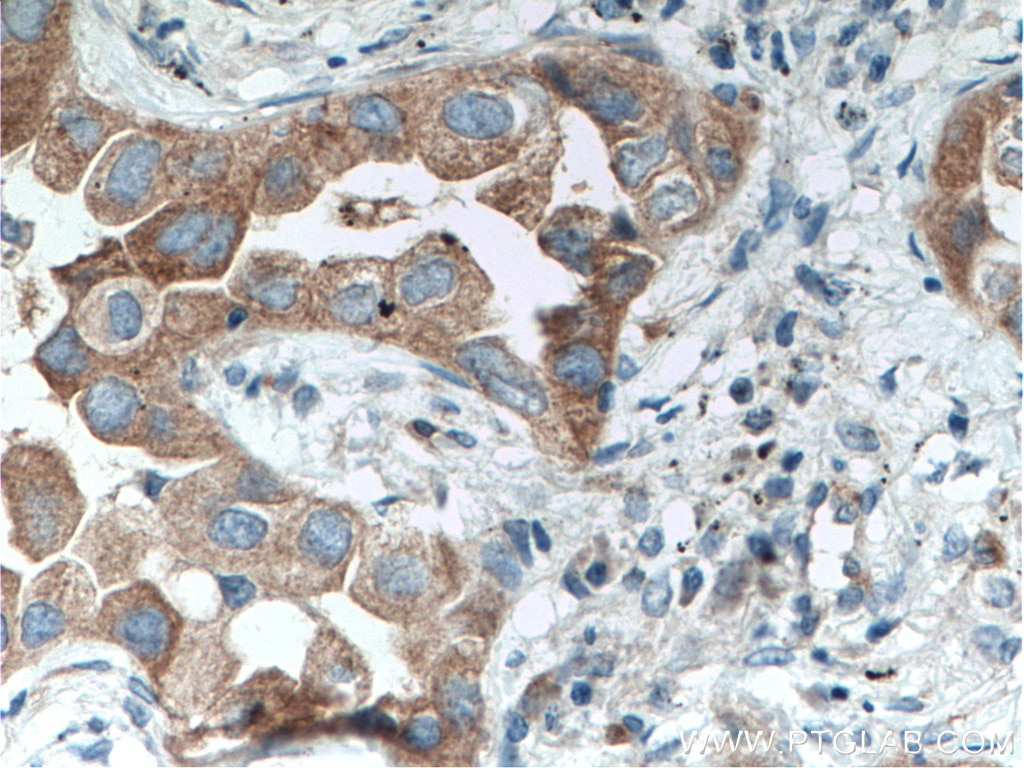 Immunohistochemistry (IHC) staining of human lung cancer tissue using TACC2 Polyclonal antibody (11407-1-AP)