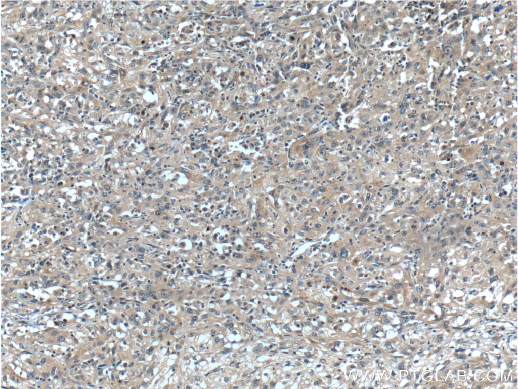 Immunohistochemistry (IHC) staining of human cervical cancer tissue using TACC3 Polyclonal antibody (25697-1-AP)