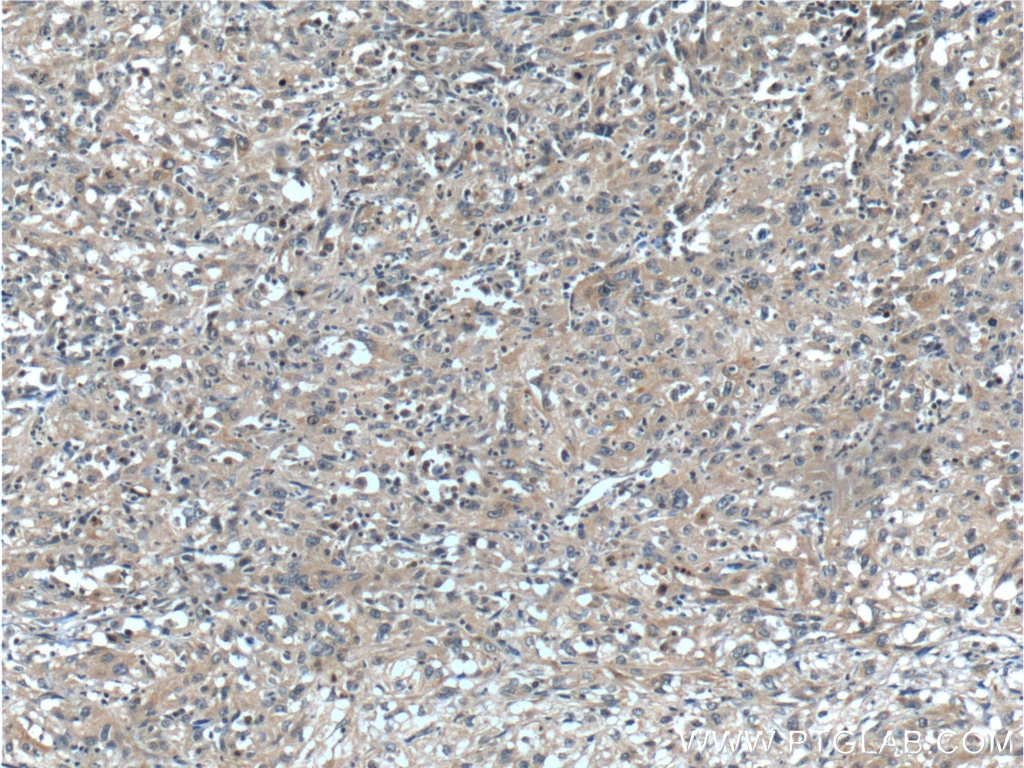 Immunohistochemistry (IHC) staining of human cervical cancer tissue using TACC3 Polyclonal antibody (25697-1-AP)