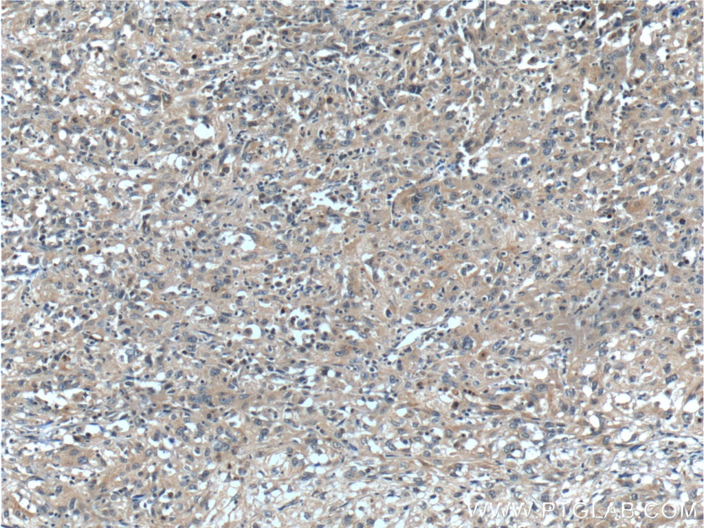 IHC staining of human cervical cancer using 25697-1-AP