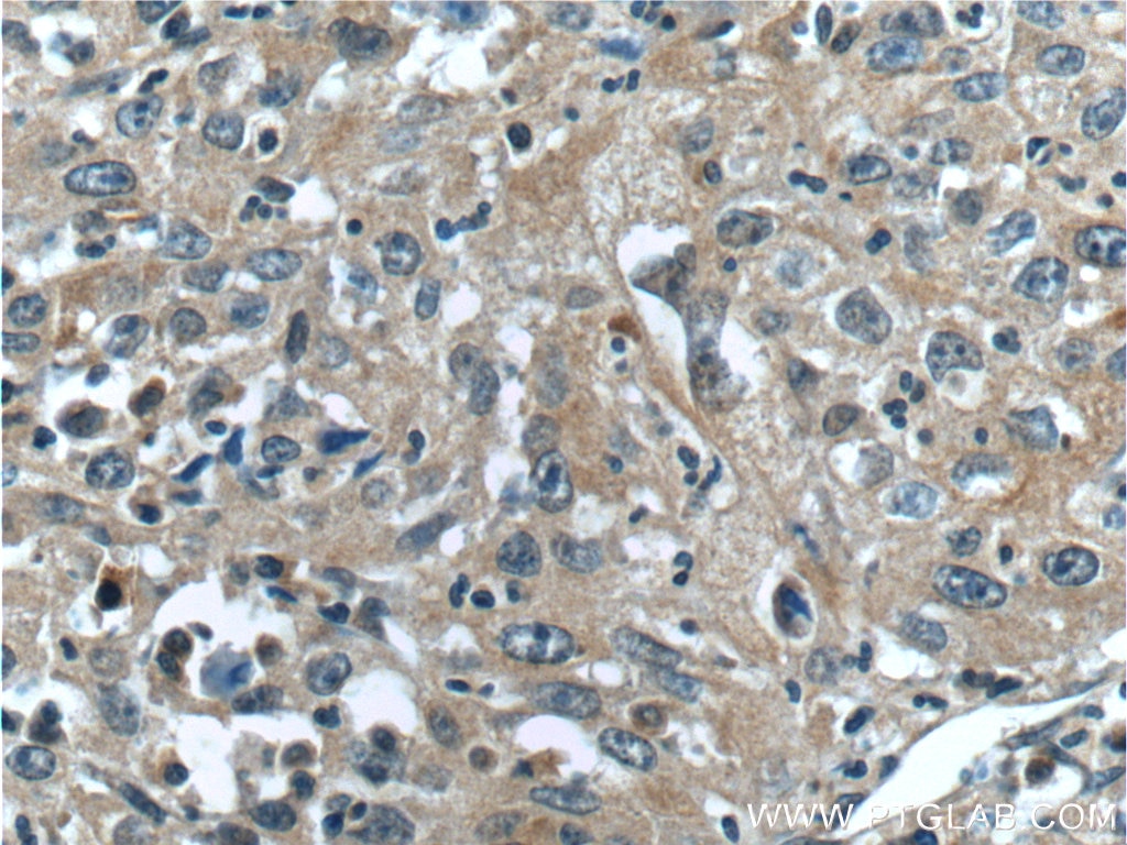 Immunohistochemistry (IHC) staining of human cervical cancer tissue using TACC3 Polyclonal antibody (25697-1-AP)