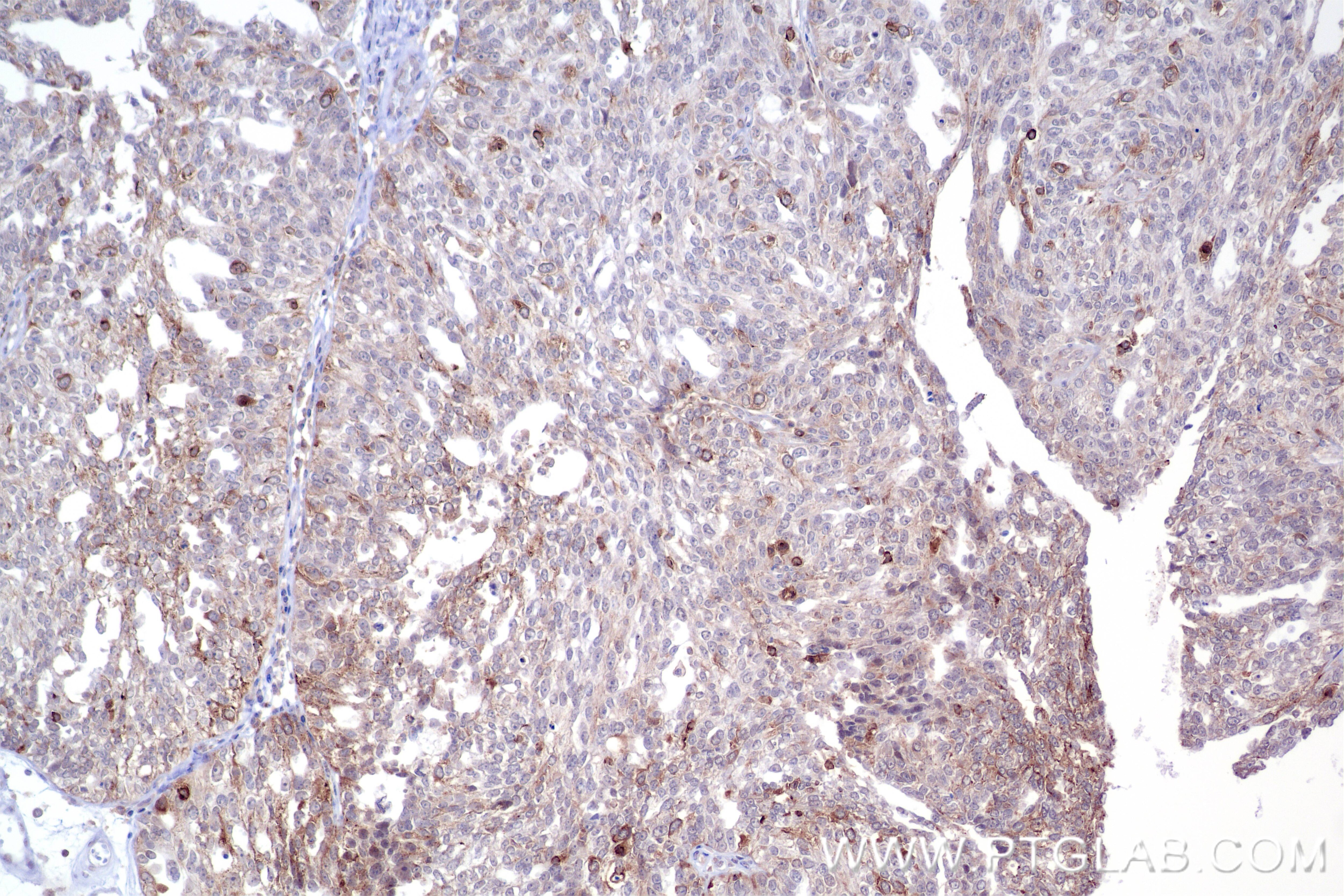 Immunohistochemical analysis of paraffin-embedded human ovary cancer tissue slide using 84940-5-RR (TACC3 antibody) at dilution of 1:500 (under 10x lens). Heat mediated antigen retrieval with Tris-EDTA buffer (pH 9.0). Immunohistochemistry (IHC) staining of human ovary cancer tissue using TACC3 Recombinant antibody (84940-5-RR)