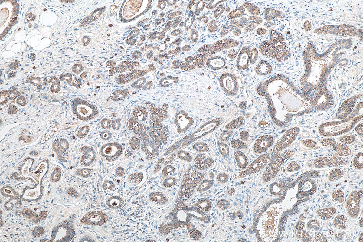 IHC staining of human breast cancer using 27360-1-AP