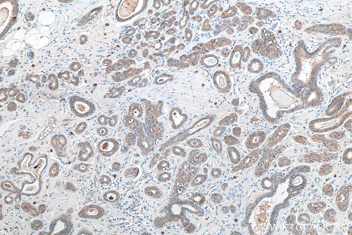 Immunohistochemistry (IHC) staining of human breast cancer tissue using TACSTD2/TROP2 Polyclonal antibody (27360-1-AP)