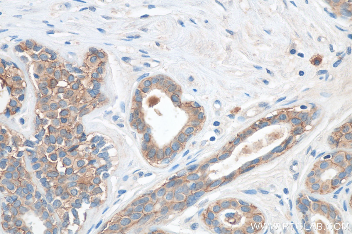 Immunohistochemistry (IHC) staining of human breast cancer tissue using TACSTD2/TROP2 Polyclonal antibody (27360-1-AP)