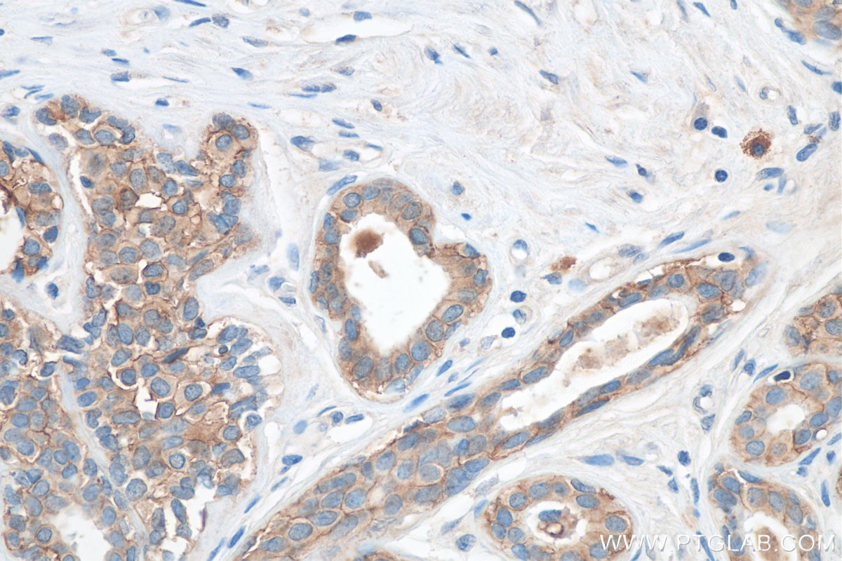 IHC staining of human breast cancer using 27360-1-AP