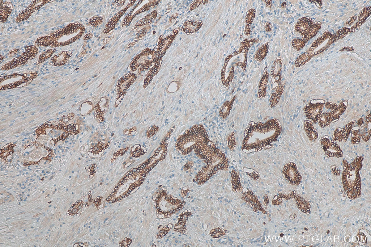 Immunohistochemistry (IHC) staining of human prostate cancer tissue using TACSTD2/TROP2 Polyclonal antibody (27360-1-AP)