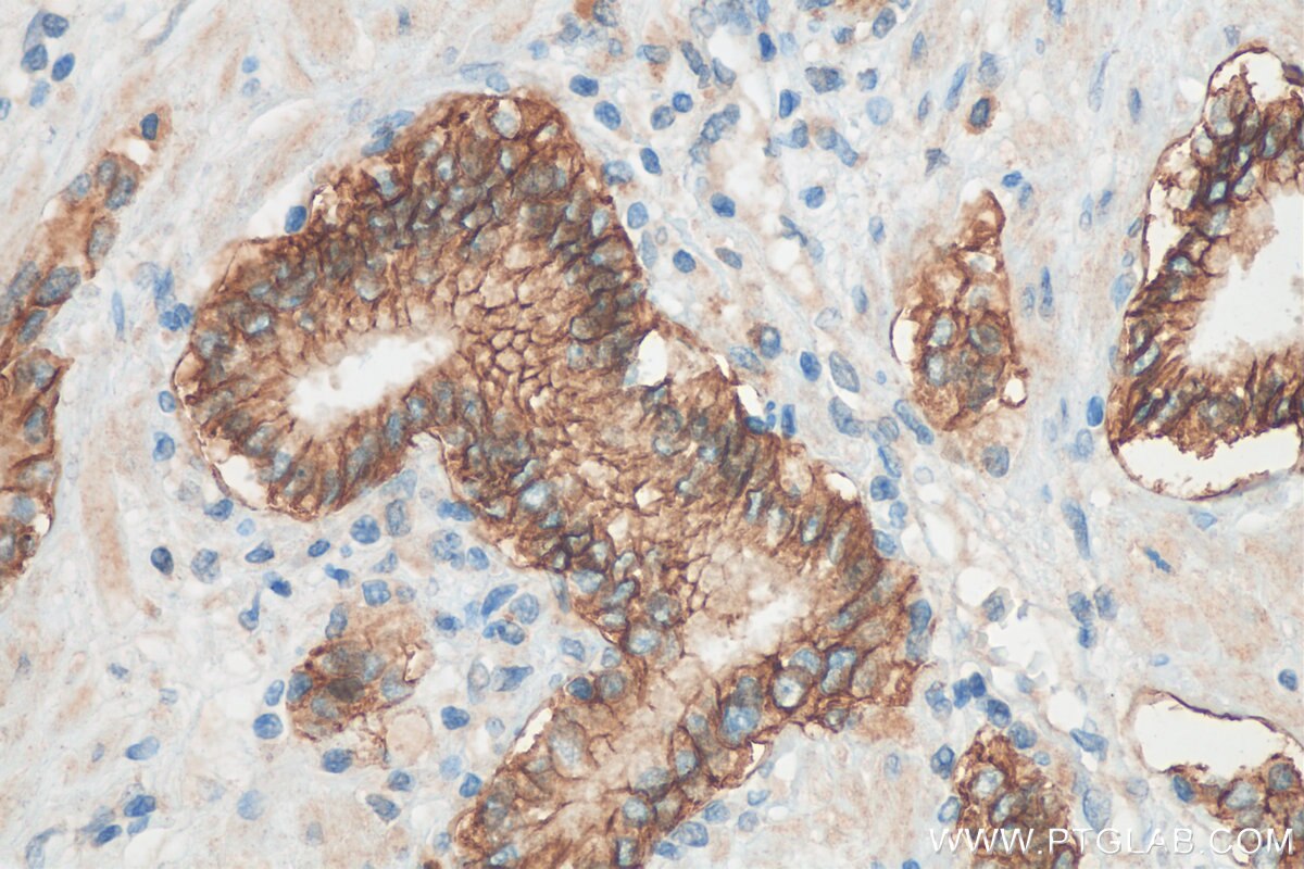 Immunohistochemistry (IHC) staining of human prostate cancer tissue using TACSTD2/TROP2 Polyclonal antibody (27360-1-AP)