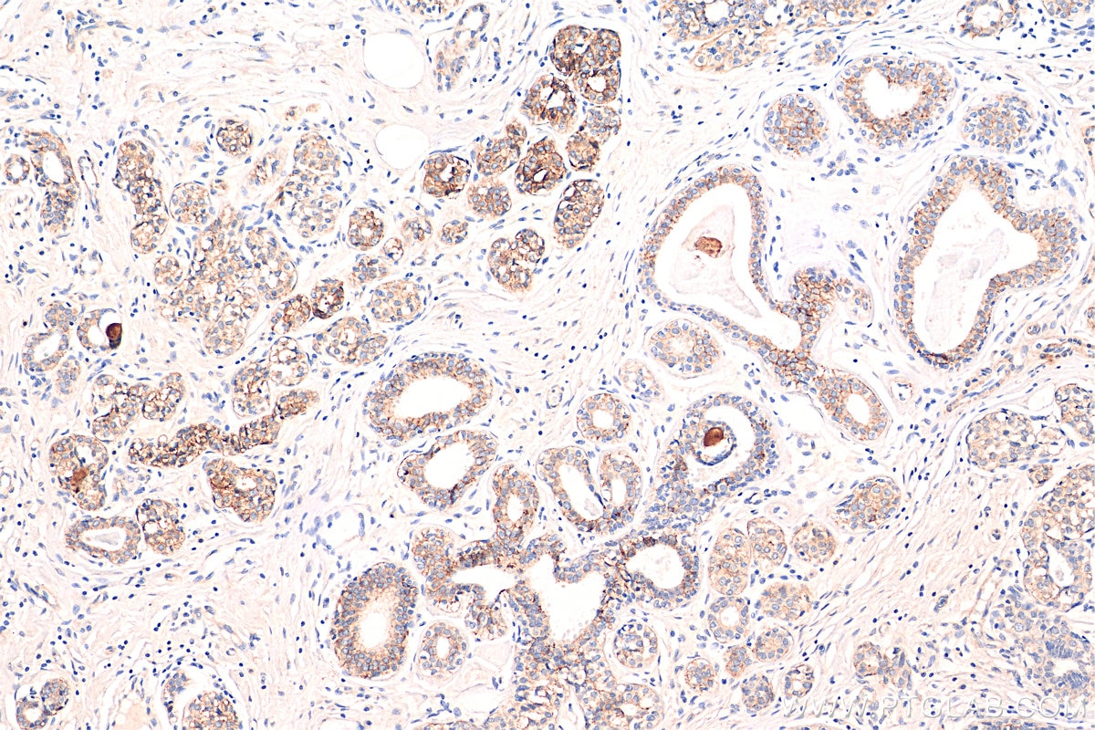 IHC staining of human breast cancer using 68141-1-Ig
