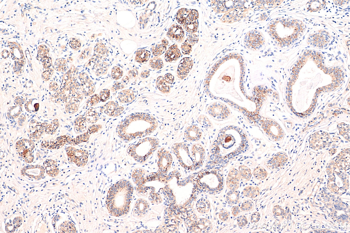 Immunohistochemistry (IHC) staining of human breast cancer tissue using TACSTD2/TROP2 Monoclonal antibody (68141-1-Ig)