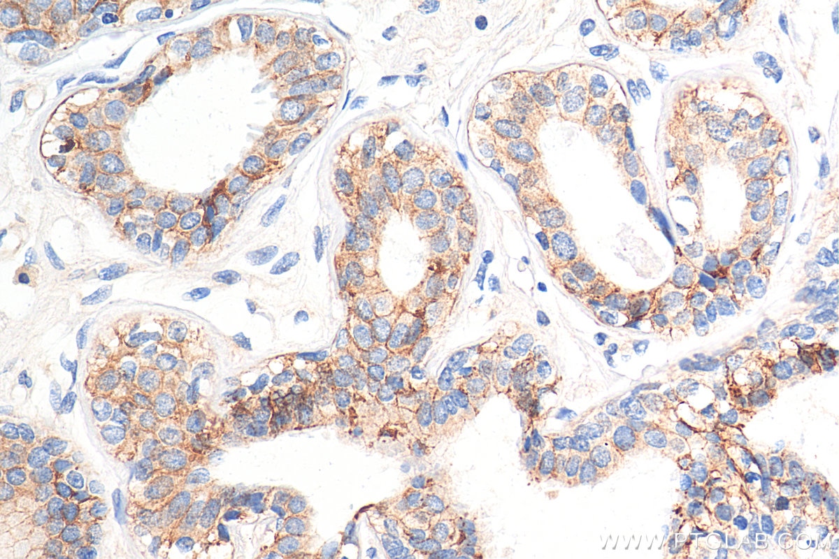 Immunohistochemistry (IHC) staining of human breast cancer tissue using TACSTD2/TROP2 Monoclonal antibody (68141-1-Ig)