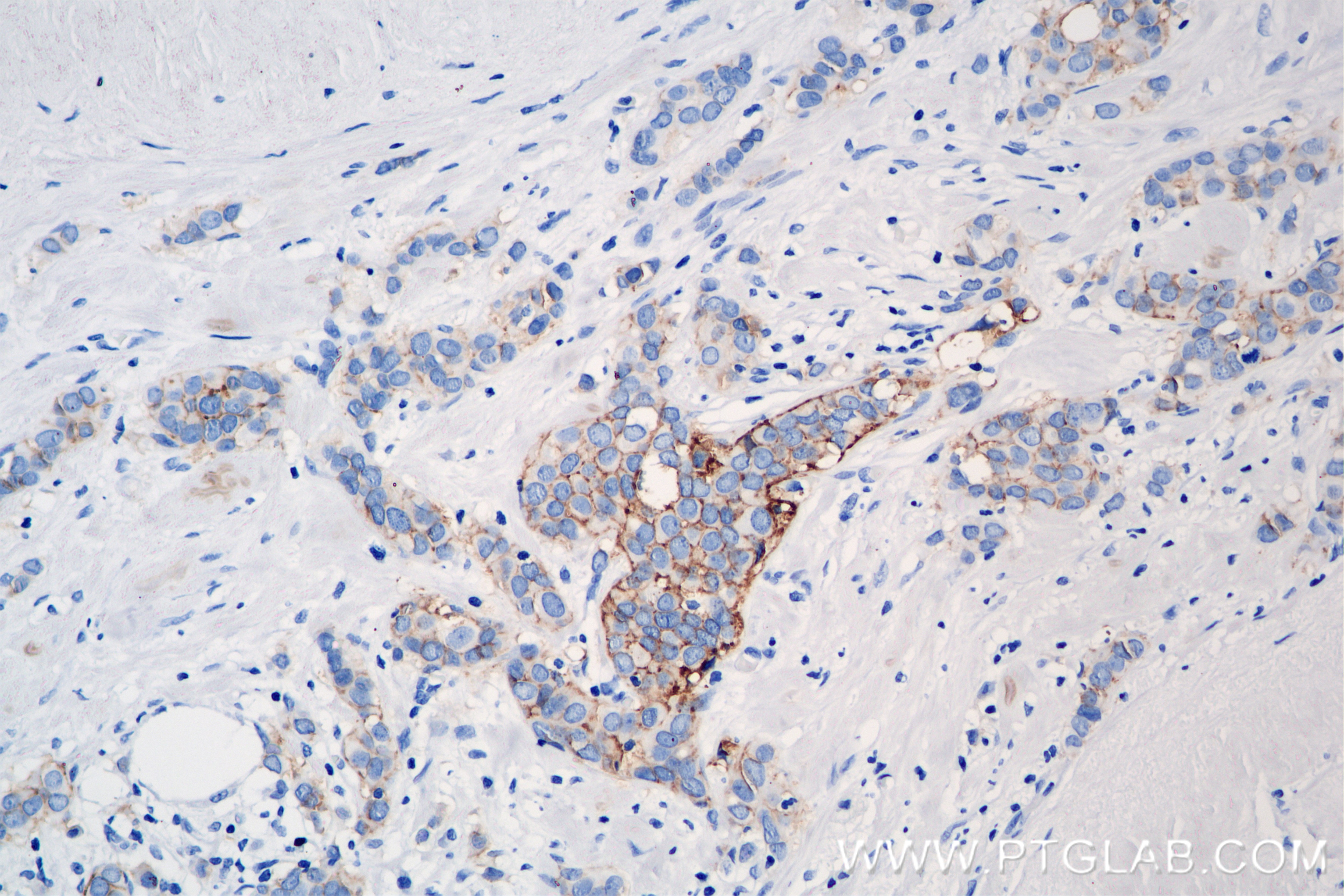 Immunohistochemical analysis of paraffin-embedded human breast cancer tissue slide using 86155-1-RR (TACSTD2/TROP2 antibody) at dilution of 1:500 (under 20x lens). Heat mediated antigen retrieval with Tris-EDTA buffer (pH 9.0). Immunohistochemistry (IHC) staining of human breast cancer tissue using TACSTD2/TROP2 Recombinant antibody (86155-1-RR)