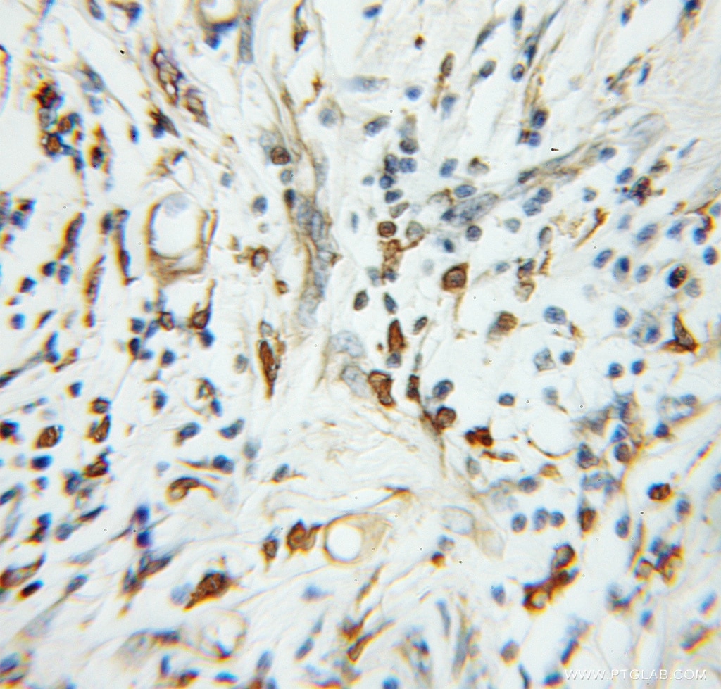 Immunohistochemistry (IHC) staining of human colon cancer tissue using TADA2L Polyclonal antibody (11299-1-AP)