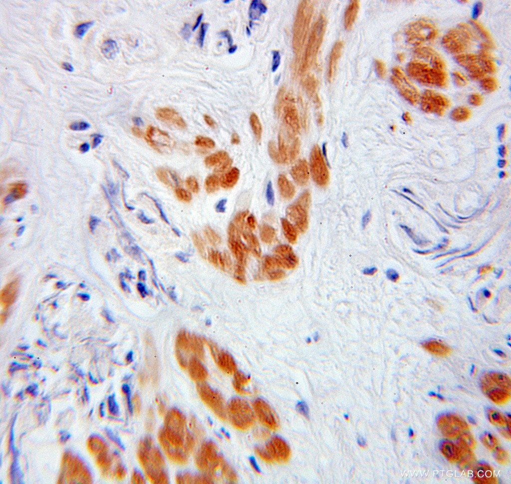 Immunohistochemistry (IHC) staining of human prostate cancer tissue using TADA3L Polyclonal antibody (10839-1-AP)