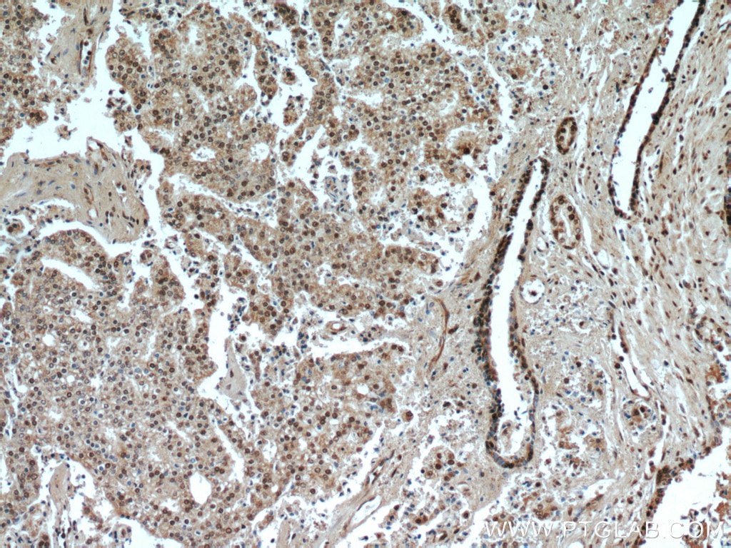 IHC staining of human prostate cancer using 20260-1-AP