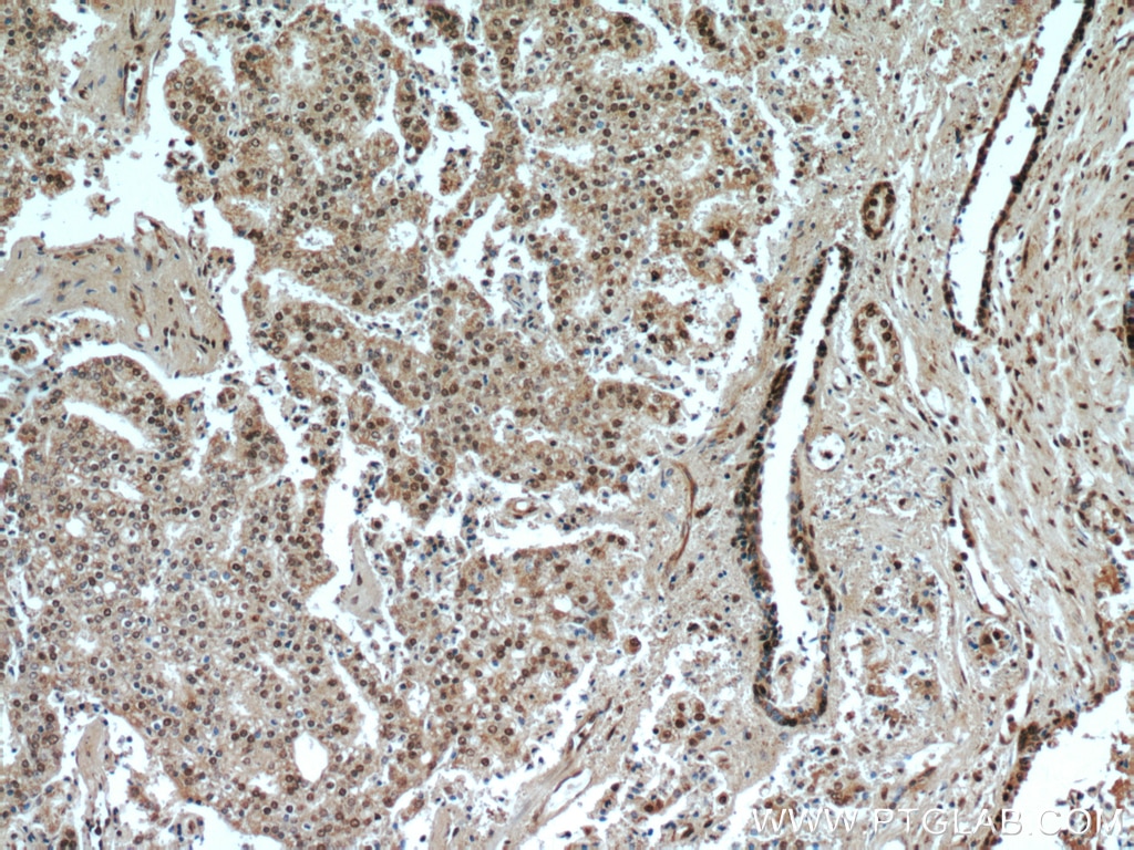 Immunohistochemistry (IHC) staining of human prostate cancer tissue using TAF1-Specific Polyclonal antibody (20260-1-AP)