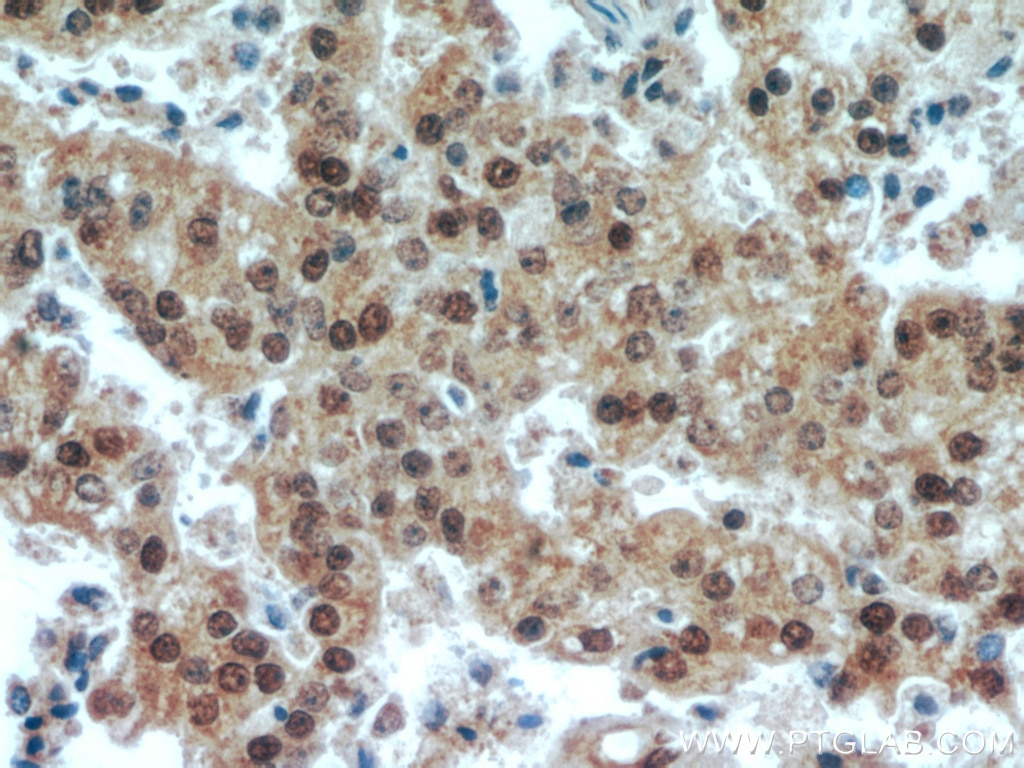 Immunohistochemistry (IHC) staining of human prostate cancer tissue using TAF1-Specific Polyclonal antibody (20260-1-AP)