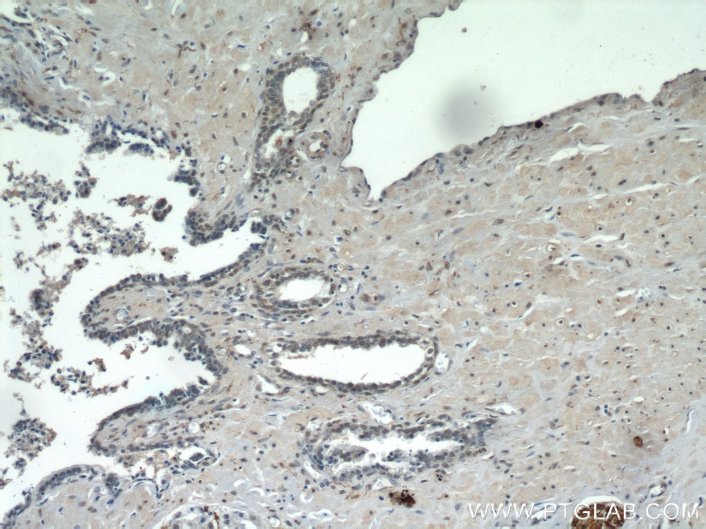 Immunohistochemistry (IHC) staining of human prostate cancer tissue using TAF1-Specific Polyclonal antibody (20260-1-AP)