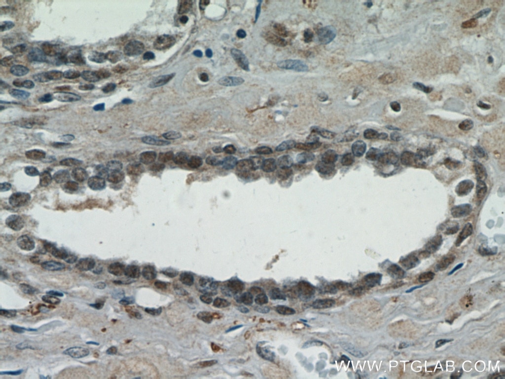 IHC staining of human prostate cancer using 20260-1-AP