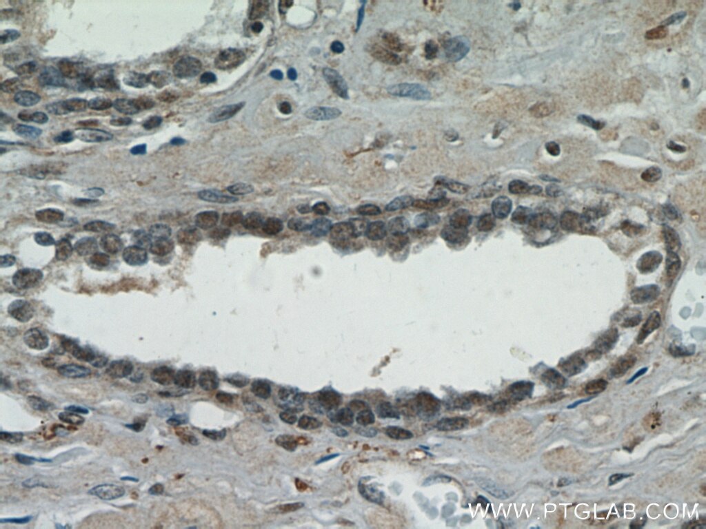 Immunohistochemistry (IHC) staining of human prostate cancer tissue using TAF1-Specific Polyclonal antibody (20260-1-AP)