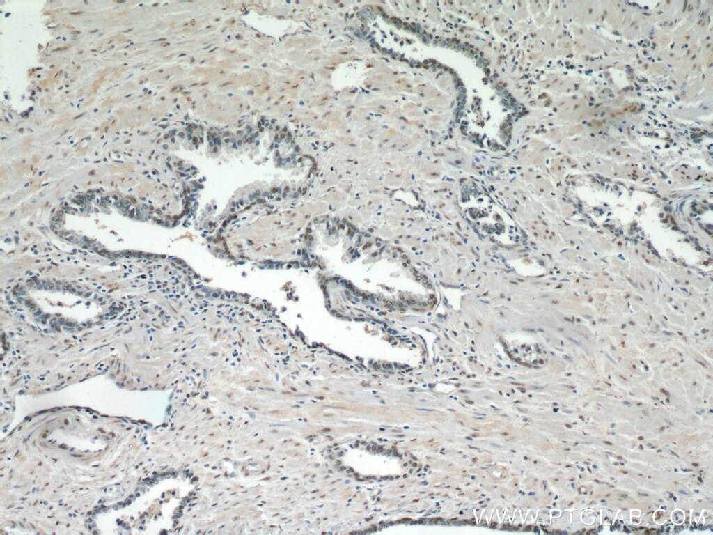 Immunohistochemistry (IHC) staining of human prostate cancer tissue using TAF1-Specific Polyclonal antibody (20260-1-AP)