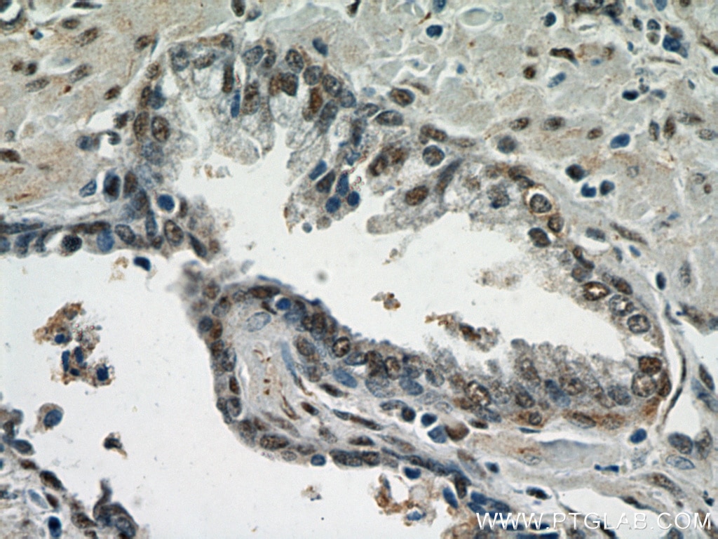 Immunohistochemistry (IHC) staining of human prostate cancer tissue using TAF1-Specific Polyclonal antibody (20260-1-AP)